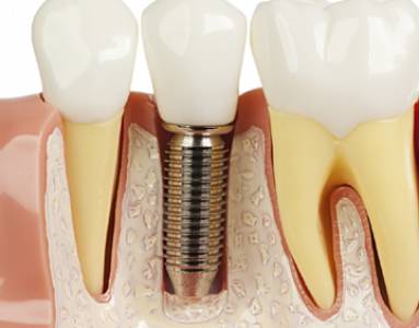 Dental Implants