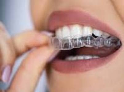 aligners