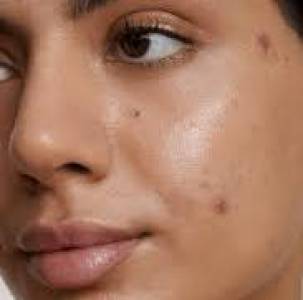 Acne Removal