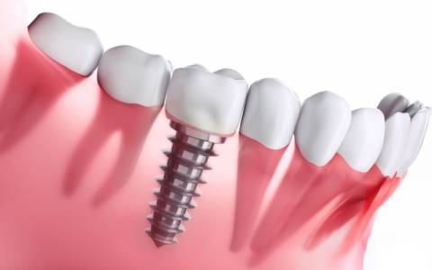 Dental Implant for One Tooth