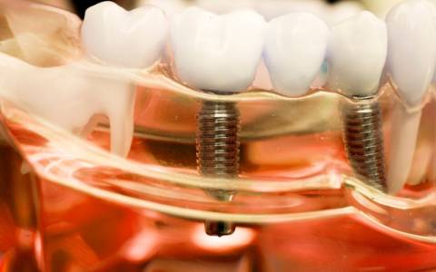 Dental Implants For Multiple Missing Teeth
