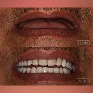 Removable Dentures