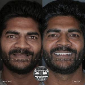 Full mouth fix denture