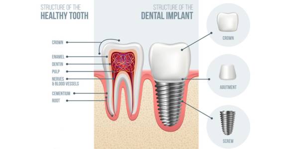 Single Dental Implants in Indore