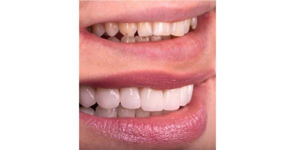 Dental Filling in Indore