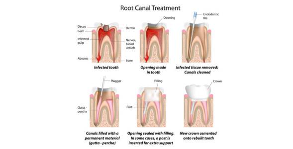 root canal in indore