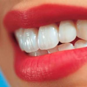 Tooth whitening