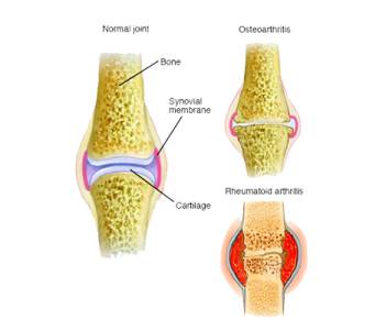 Arthritis Treatment