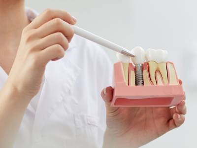 Dental Implants