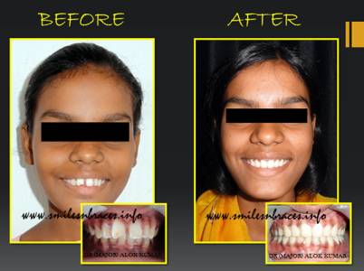 Retrusion Of Lower Jaw Corrected By Removable Functional Appliance