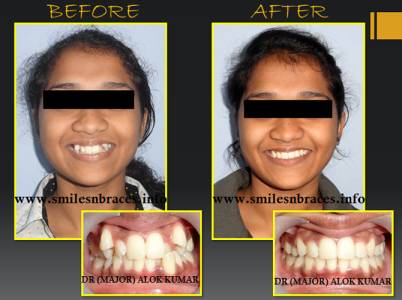 Severe Crowding Treated By All First Premolar Extraction