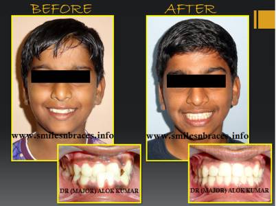 Skeletal Class III Treated By Orthopaedic Appliance Followed By Fixed Ortho.
