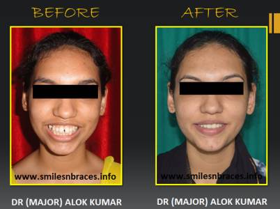 Spacing & Proclination Corrected By Fixed Orthodontics