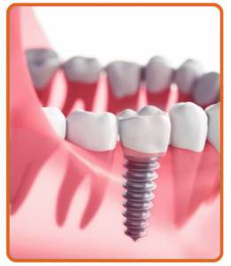 Dental Implants