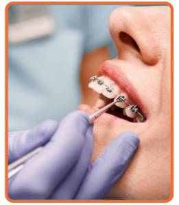 Braces Dental
