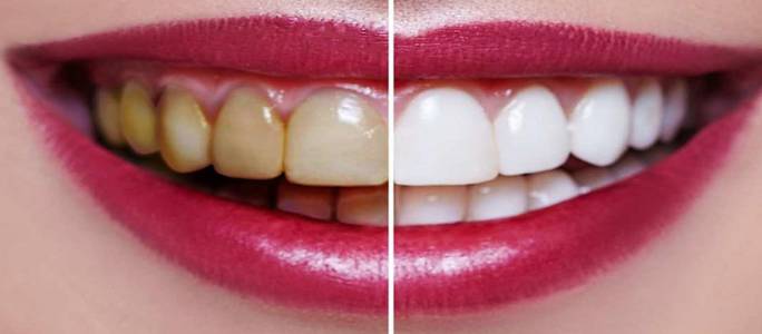 Tooth Whitening
