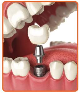 Dental Implants Treatment