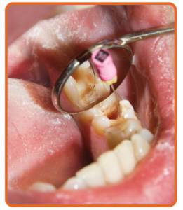 Dental Restoration