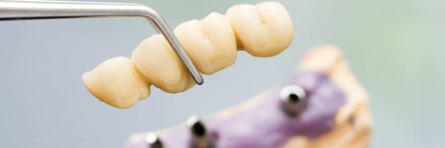 Dental Bridges