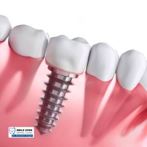 Dental Implants