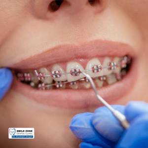 Orthodontic Treatments