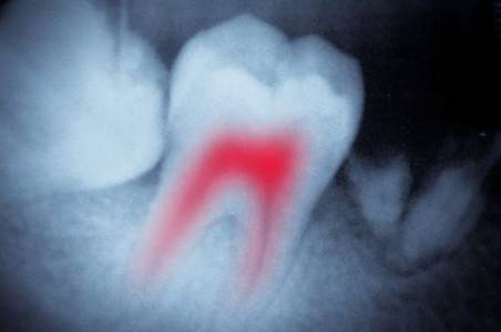 root canal