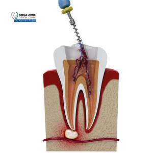 root canal