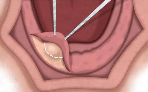 Preprosthetic Surgery