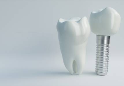 Dental Implant