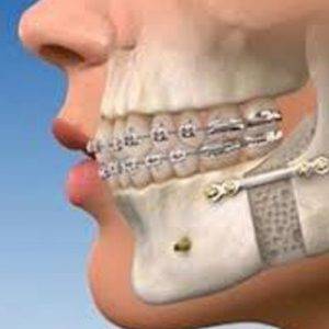 ORTHOGNATHIC SURGERY