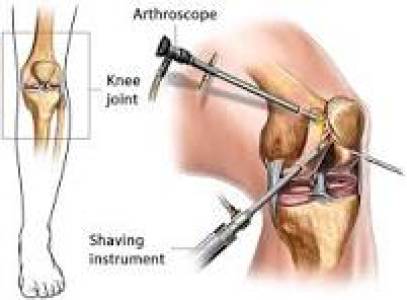 Arthroscopy
