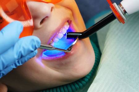 Dental fillings