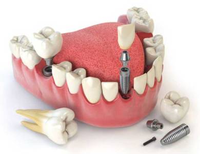 Dental Implants