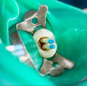 Root Canal