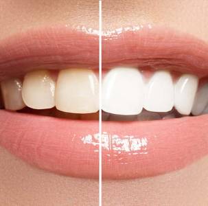 Teeth Instant Whitening