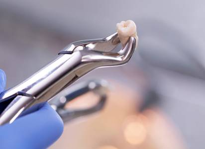 Tooth Extraction