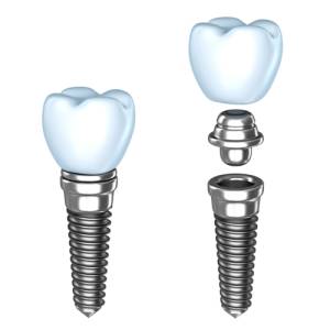 Dental Implant