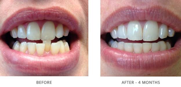 Orthodontic treatment