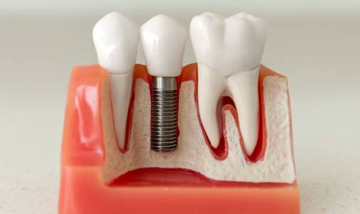 Dental Implants