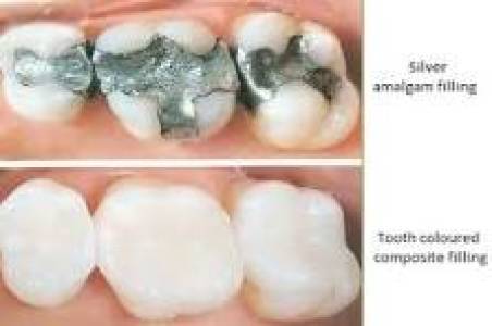 dental filling