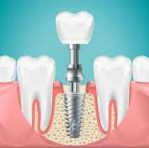 dental implants