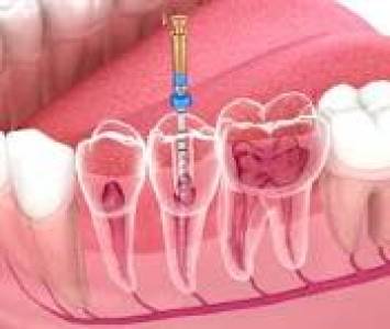 root canal