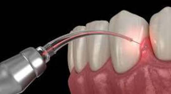 Laser Teeth Whitening