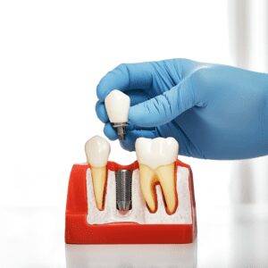 Dental Implant