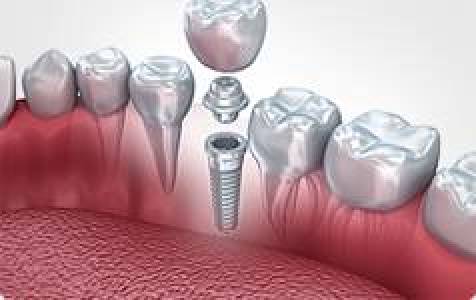 Dental Implant