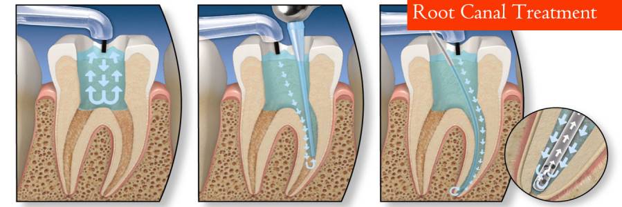 Root Canal