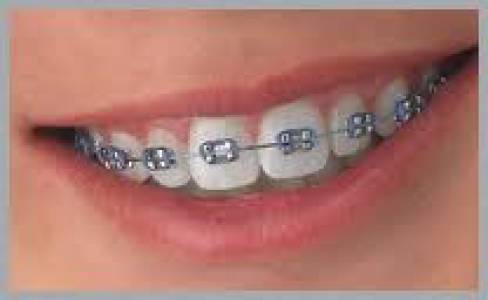 fixed orthodontics