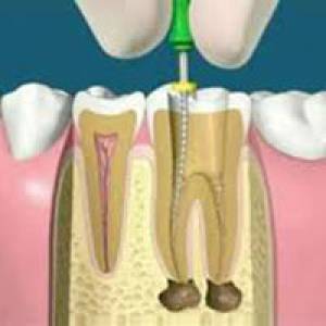 Root Canal