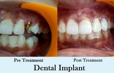 Dental Implant