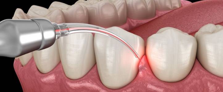 Dental LASER